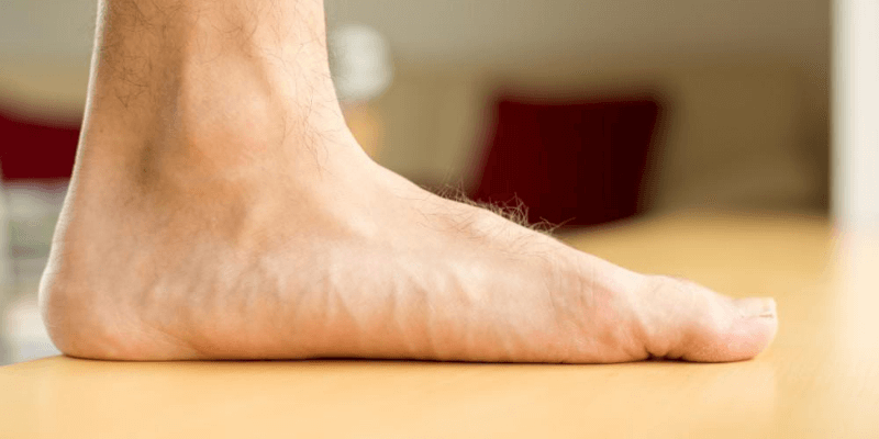 Flat Feet