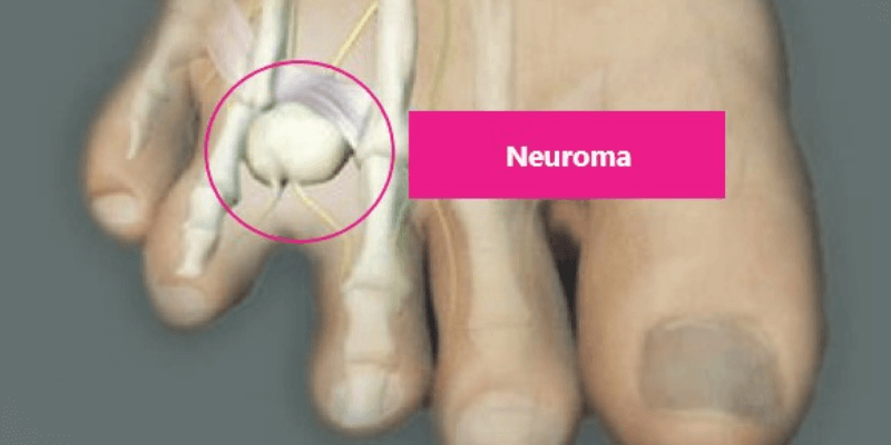 Neuroma