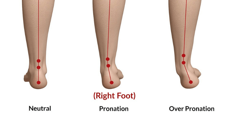 Overpronation